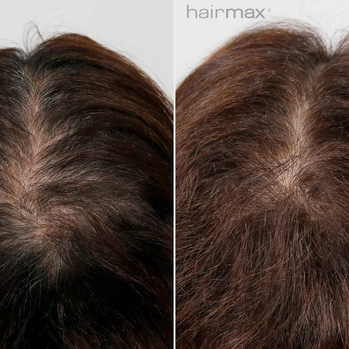 Oryginalna laserowa opaska przeciw wypadaniu włosów i AGA LaserBand 82, HairMax