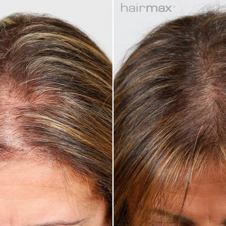 Oryginalna laserowa opaska przeciw wypadaniu włosów i AGA LaserBand 82, HairMax