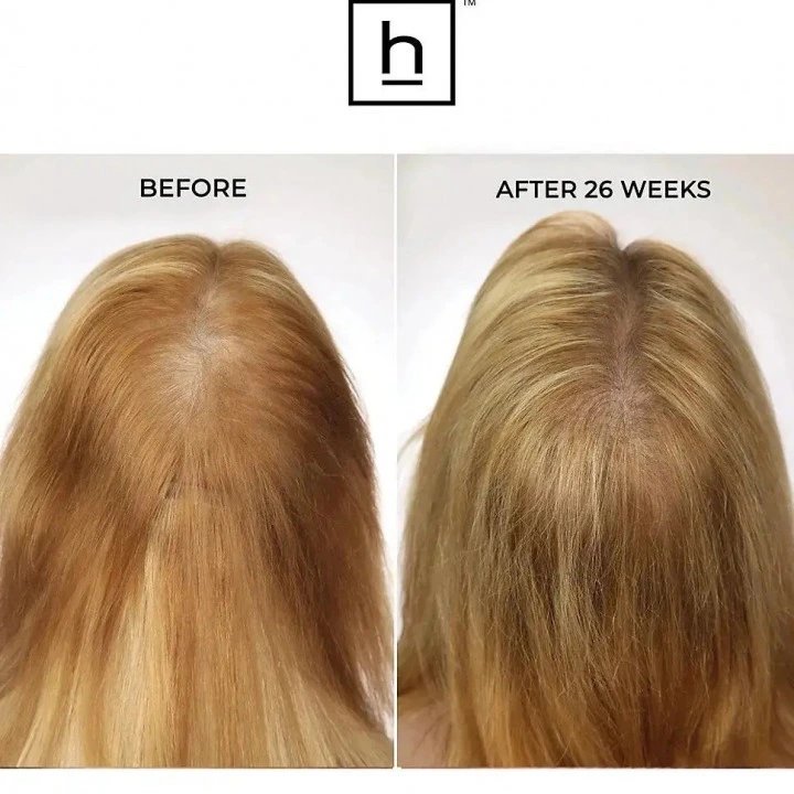 Oryginalna laserowa opaska przeciw wypadaniu włosów i AGA LaserBand 82, HairMax