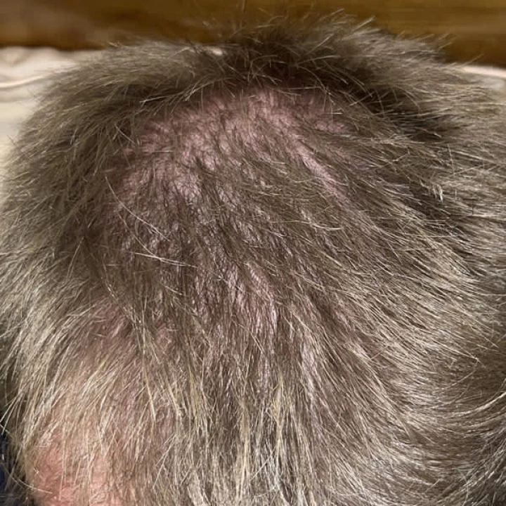 Serum na przerzedzenie i AGA, cynk, biotyna, rozmaryn, kofeina, palma sabalowa, pieprz, Pura Dor