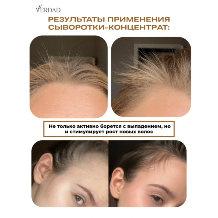 Сыворотка-концентрат от выпадения волос с Capixyl, розмарин, цинк, медь, НАБОР 2 уп, Verdad