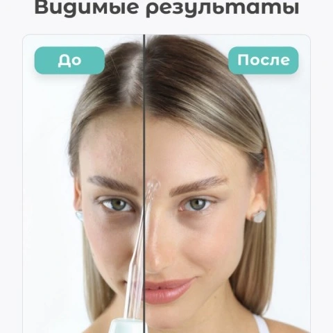 Дарсонваль Biolift4 118 для волос, лица и тела, 4 насадки, белый, Gezatone
