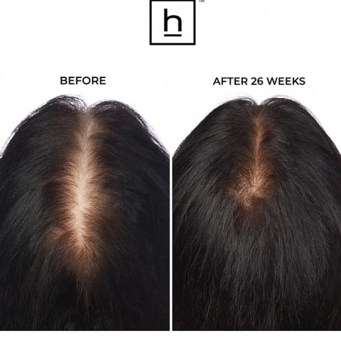 Лазерный терапевтический обруч HairMax LaserBand 41, HairMax