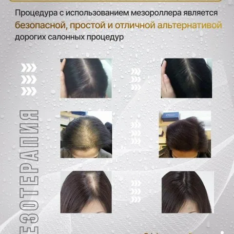 Дермароллер для активации и повышения густоты волос с позолоченными иглами, Wheneva